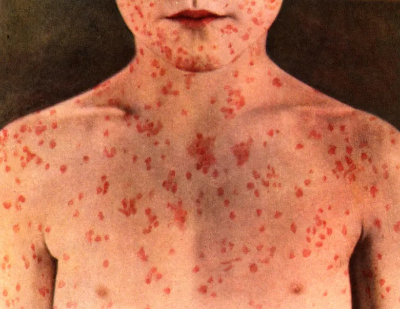 Peste 100 de noi cazuri de rujeolă în România. Câte cazuri au fost confirmate în Dâmbovița