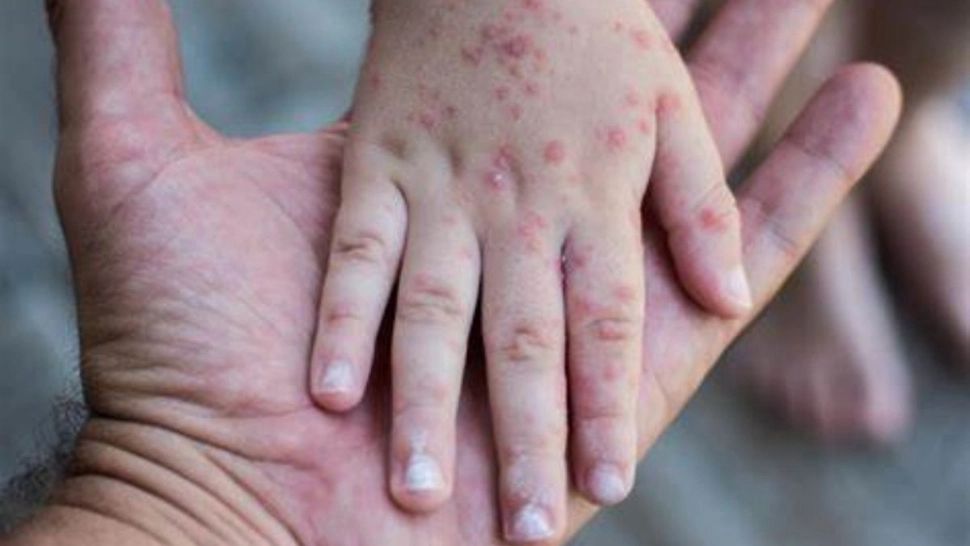 România, pe primul loc în UE la cazurile de rujeolă! Efectul dramatic al prăbușirii ratei de vaccinare în rândul copiilor