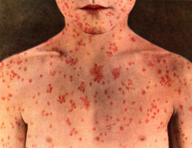 Un caz de rujeolă, confirmat în Dâmbovița. Harta județelor în care a apărut virusul