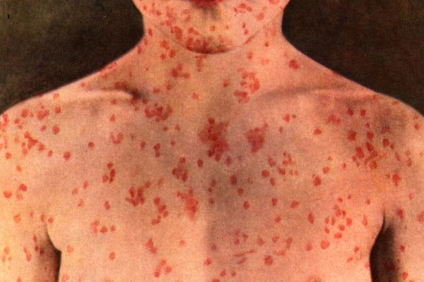 Încă nouă cazuri de rujeolă au fost confirmate în ultima săptămână în patru judeţe