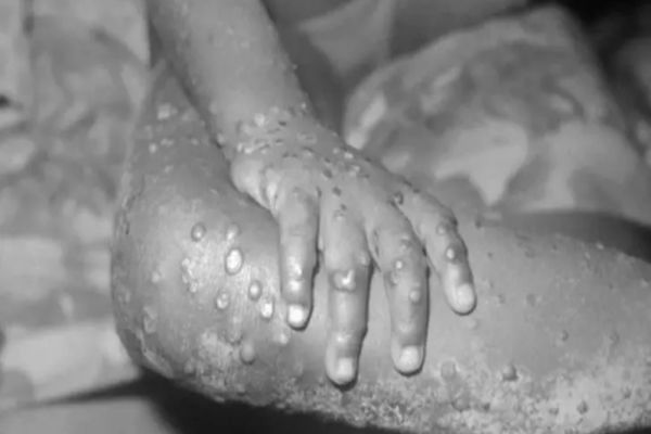 Două noi cazuri de variola maimuței depistate în România